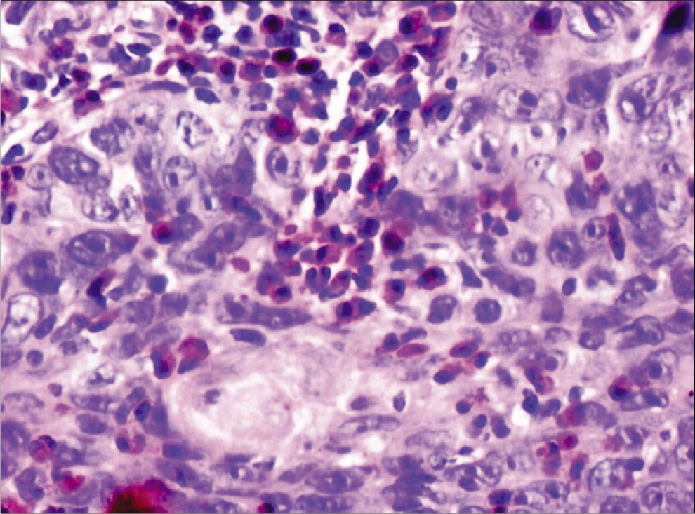 Tumor-associated tissue eosinophilia in well-differentiated squamous cell carcinoma (×40), carbol chromotrope stain.