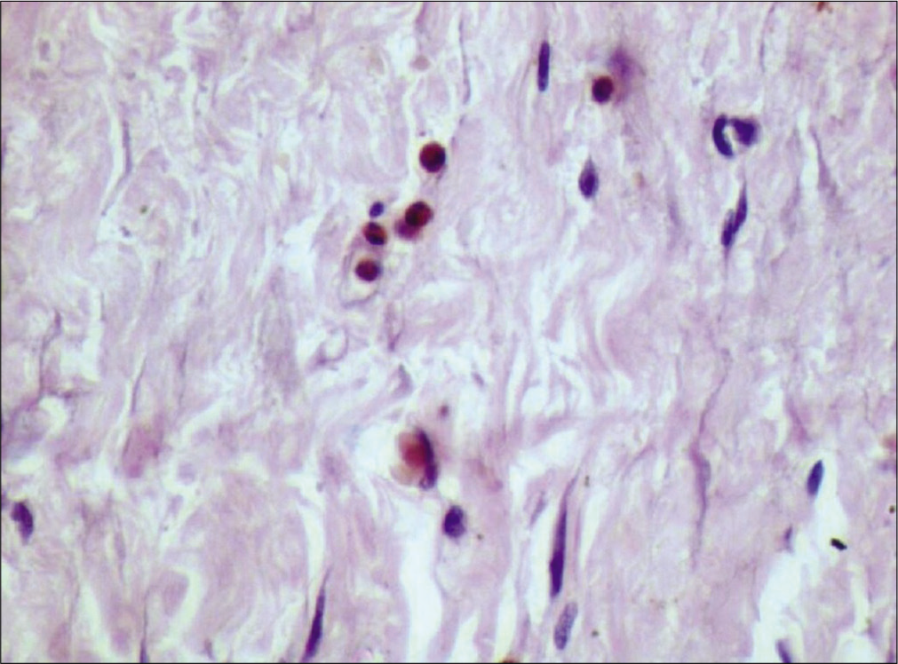 Tumor-associated tissue eosinophilia in poorly differentiated squamous cell carcinoma (×40), carbol chromotrope stain.