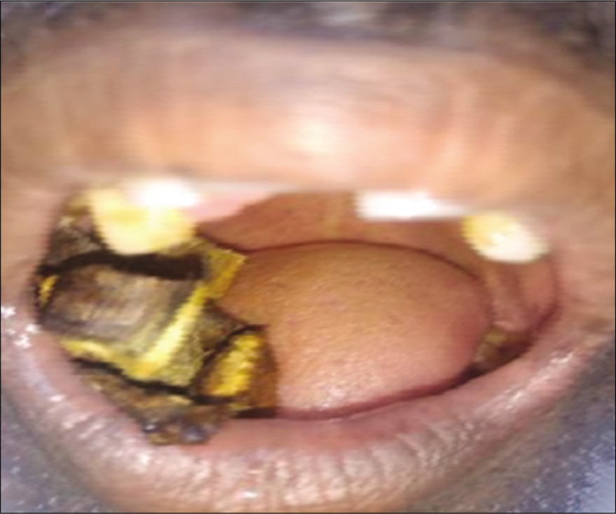 Clinical picture of new variant of tobacco (BONDAKUTCHI) users.