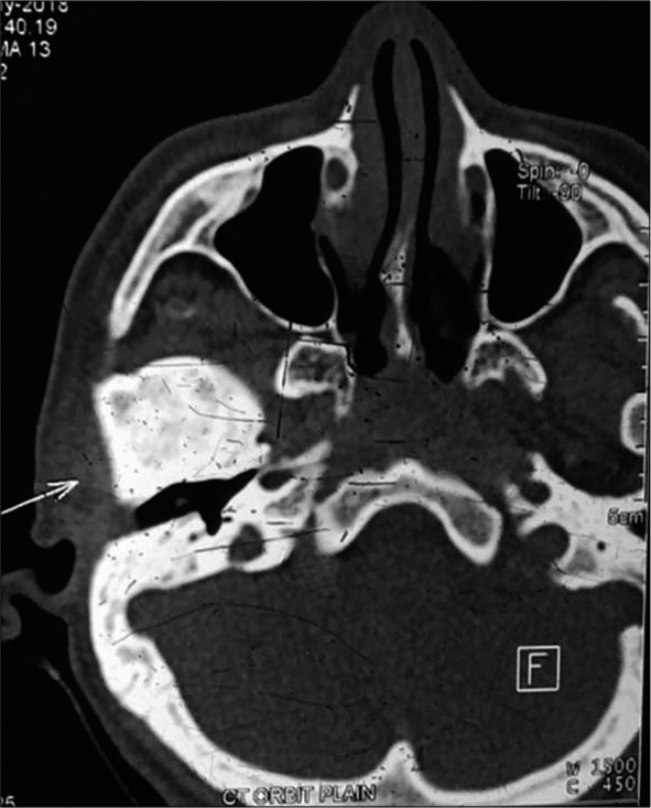Pre-operative CT showing the ankylotic mass.
