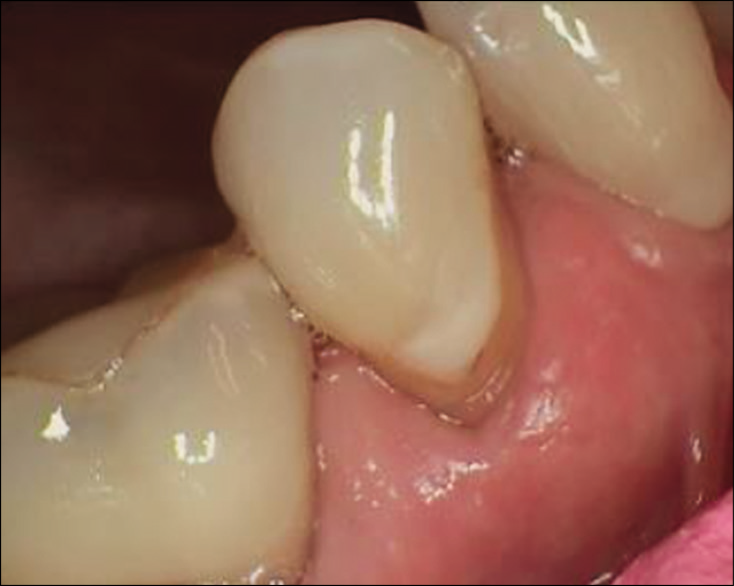 Facial-cervical composite placed in 1989 (32 years old).