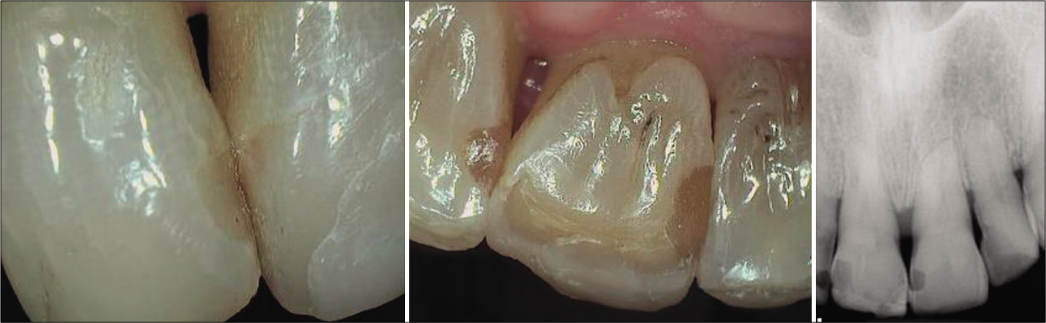 #7 mesiofacial; #8 distolingual, and #9 mesiolingual. Placed in mid-1970s. Still in service.