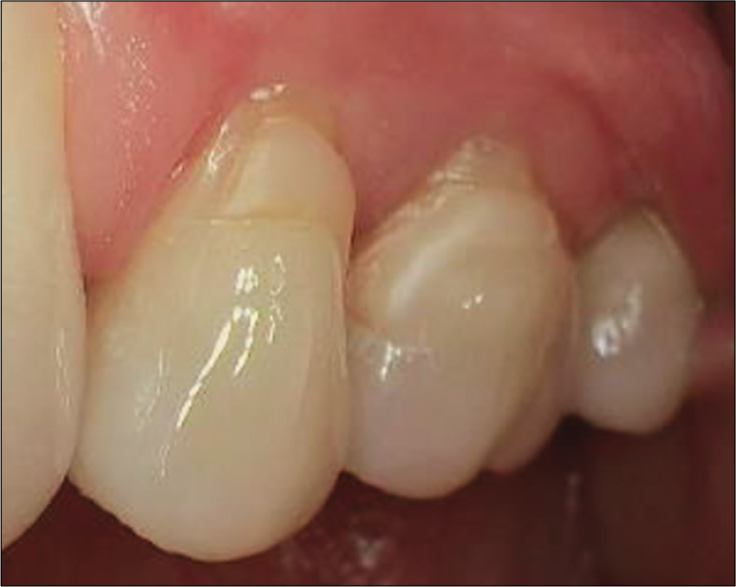 A 13-year successful composite. Apical cervical wear beyond.