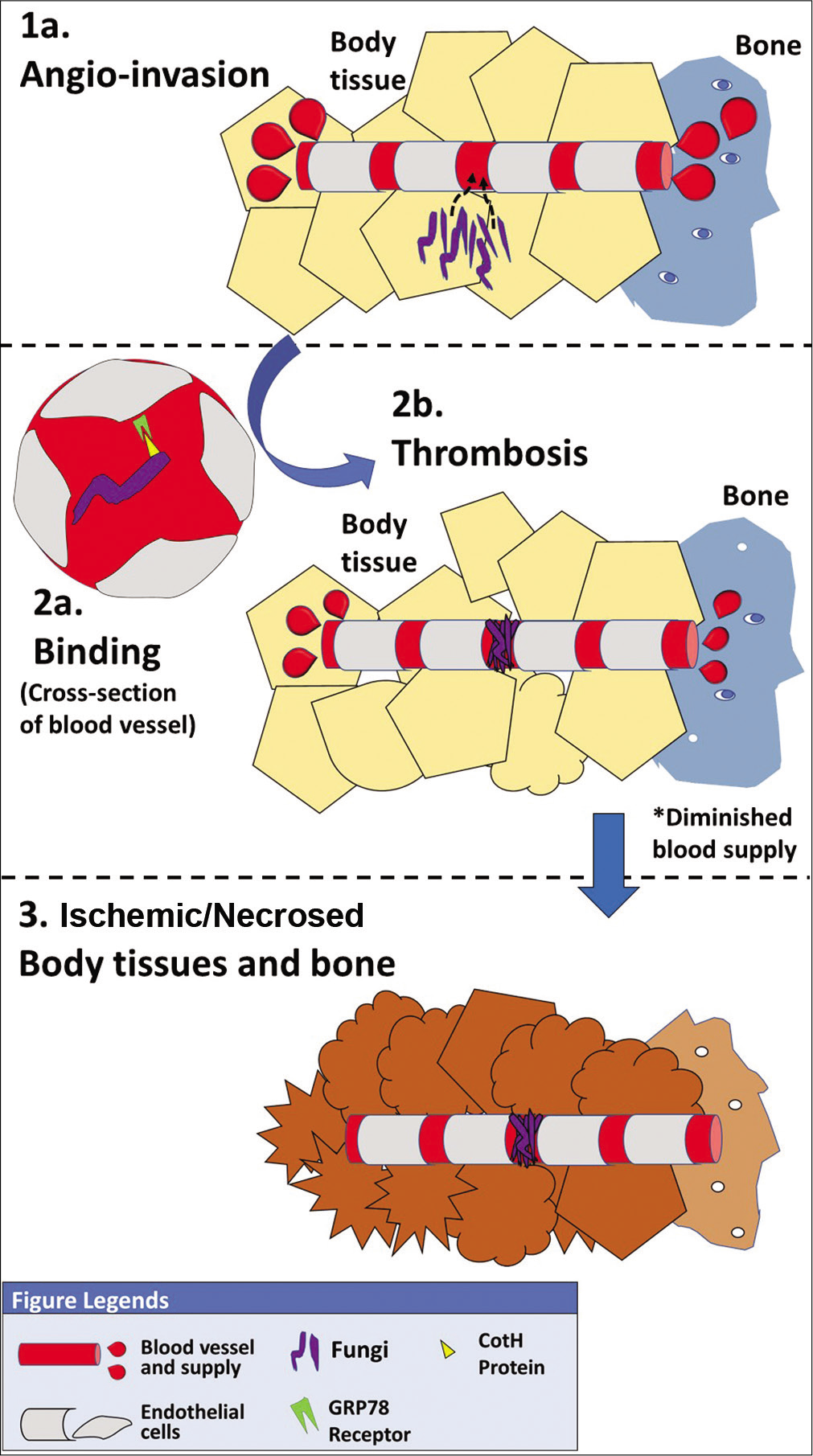 Pathogenetic process of mucormycosis.