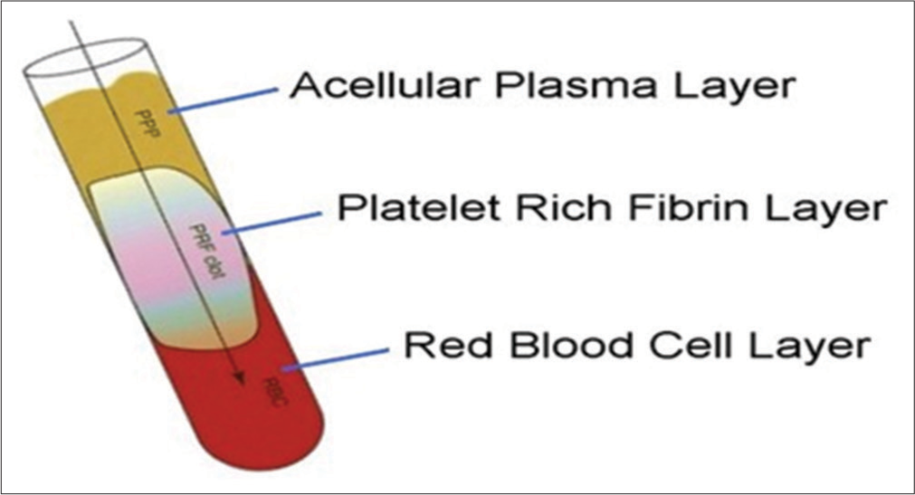 PRF follows the preparation protocol and is divided into three parts: (1) Upper part – Acellular plasma layer, (2) Middle part – Platelets-rich fibrin, (3) Lower part – Red blood cell layer.