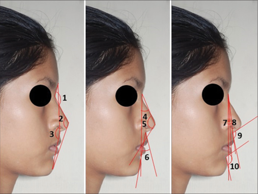 Angular measurements on Photograph: (1) Nasofrontal angle, G’-N’-Nd’, (2) Total facial angle, N’-Prn’-Pg’, (3) Facial angle, G’-Sn’-Pg’, (4) Nasomental angle, N’-Prn’/N’-Pg’, (5) Nose tip angle, N’-Prn’-Cm’, (6) Upper lip angle, Sn’-Ls’/Sn’-Pg’, (7) Projection of lower lip to chin, N’-Pg’/N’-Li’, (8) Projection of upper lip to chin, N’-Pg’/N’-Ls’, (9) Nasolabial angle, Cm’-Sn’-Ls’, (10) Mentolabial angle, Li’-Sm’-