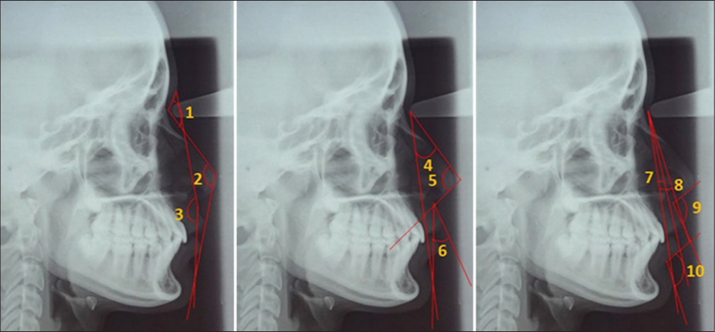 Angular measurements on Cephalogram: (1) Nasofrontal angle, G-N-Nd, (2) Total facial angle, N-Prn-Pg, (3) Facial angle, G-Sn-Pg, (4) Nasomental angle, N-Prn/N-Pg, (5) Nose tip angle, N-Prn-Cm, (6) Upper lip angle, Sn-Ls/Sn-Pg, (7) Projection of lower lip to chin, N-Pg/N-Li, (8) Projection of upper lip to chin, N-Pg/N-Ls, (9) Nasolabial angle, Cm-Sn-Ls, (10) Mentolabial angle, Li-Sm-Pg.