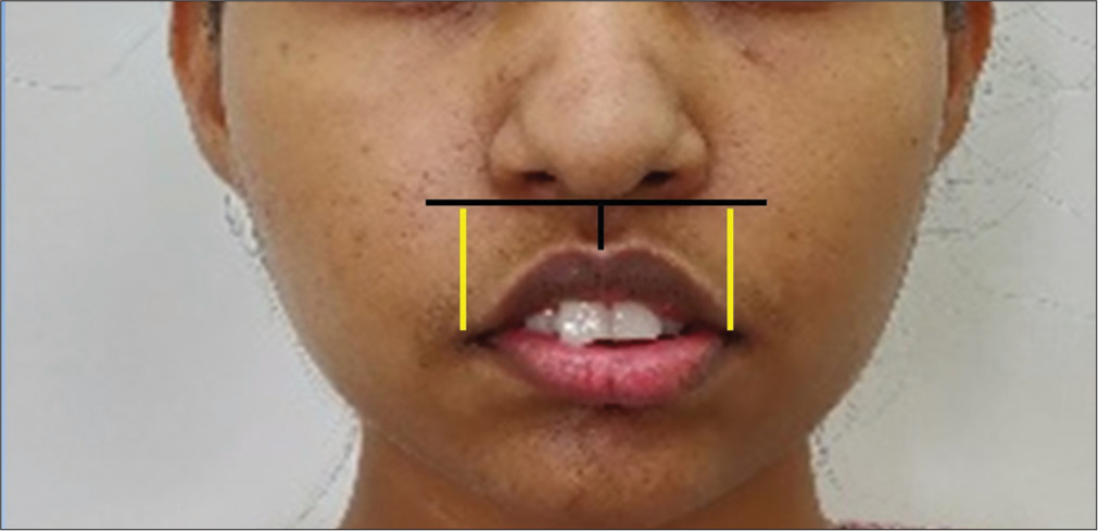 Gull lip (Reverse lip curvature).