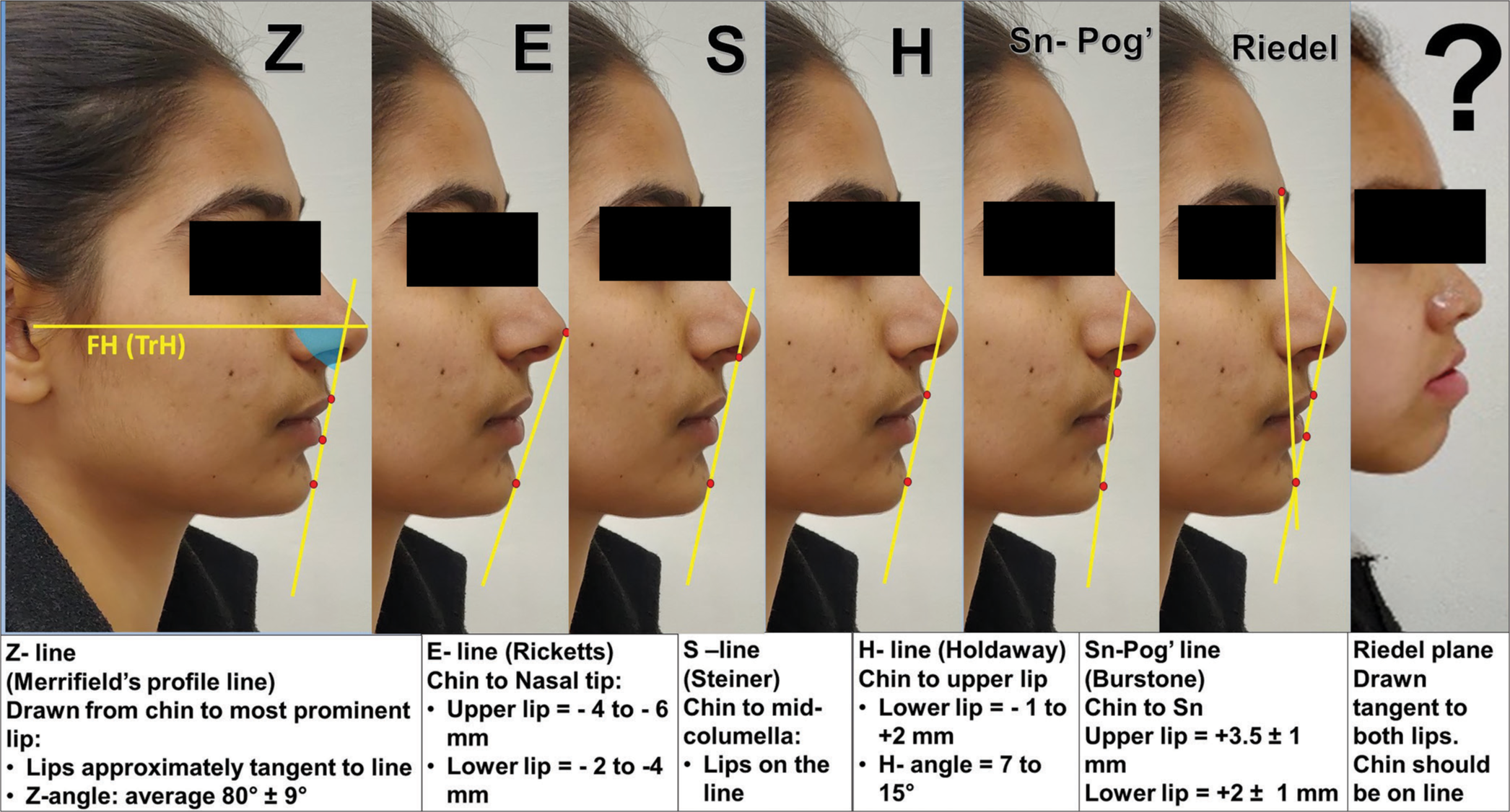 Profile analysis. FH: Frankfort horizontal plane, TrH: True horizontal plane. (?) An aberrant facial profile, an aberrant soft-tissue profile as mentioned in the text is shown as Figure 4 (?).