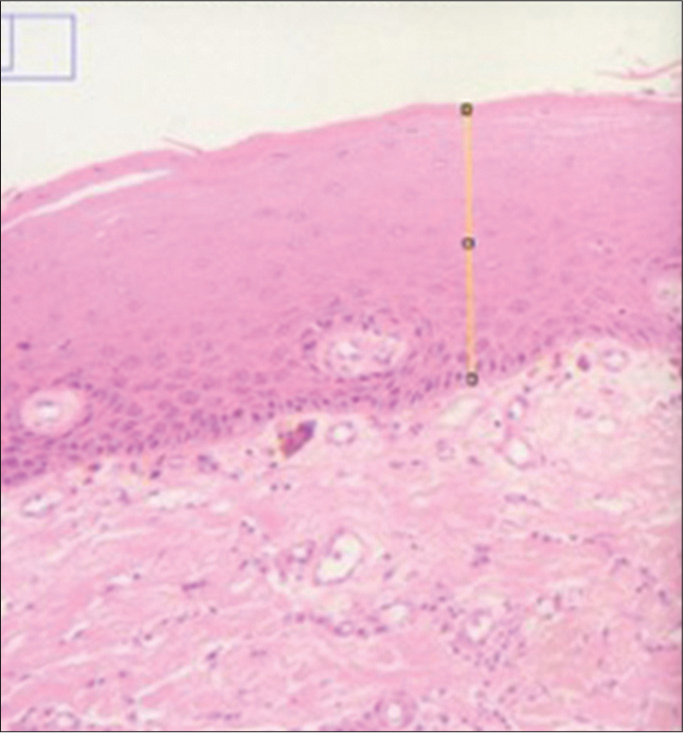 Measurement of epithelial thickness. 3 points from the epithelial surface to epithelial connective tissue interface are measured in 3 different fields.