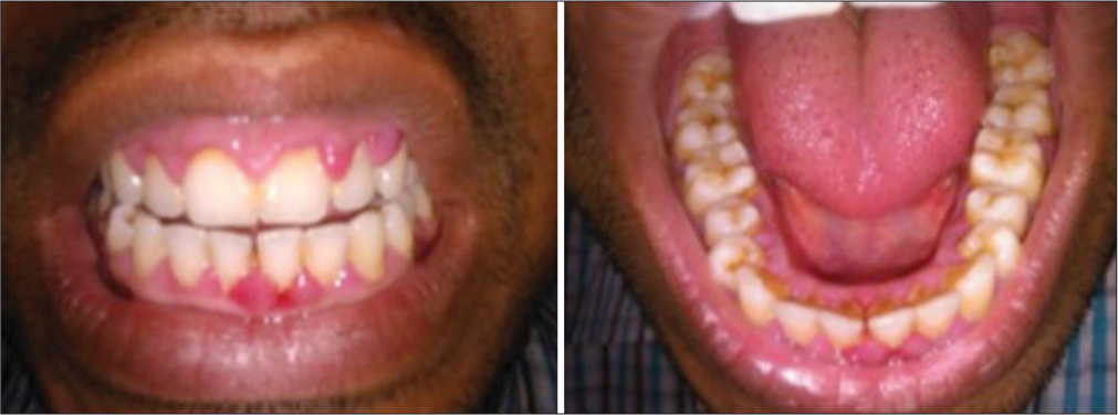 Moderate gingival enlargement, with prominent interdental papillary involvement on buccal and lingual aspect.