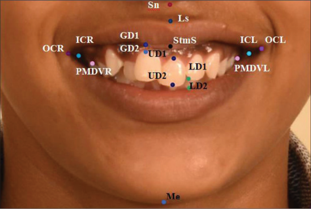 Landmarks showing in Red-Sn- Subnasale, Light Purple-Ls- Labrale superioris, Pink-PMDVR- Posterior maxillary dentition visible right and PMDVL- Posterior maxillary dentition visible left, Blue-ICR- Inner commissure right & ICL- Inner commissure left, Violet-OCR- Outer commissure right and OCL- Outer commissure left, Light violet, Black-StmS, Light Violet-GD- Gingival display-GD1 and GD2, Purple-UD1 and UD2-UD- Upper incisal display, Green-LD1 & LD2-LD- Lower incisal display, Dark violet- MeMenton.